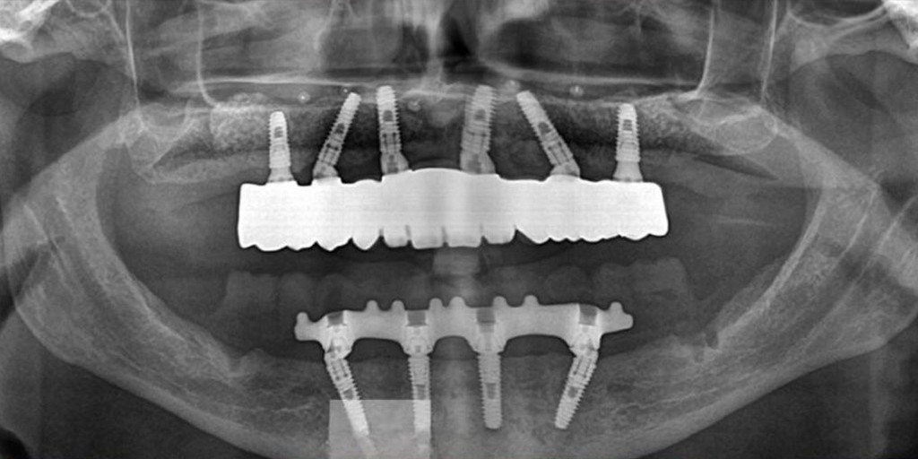 dental-implant-13